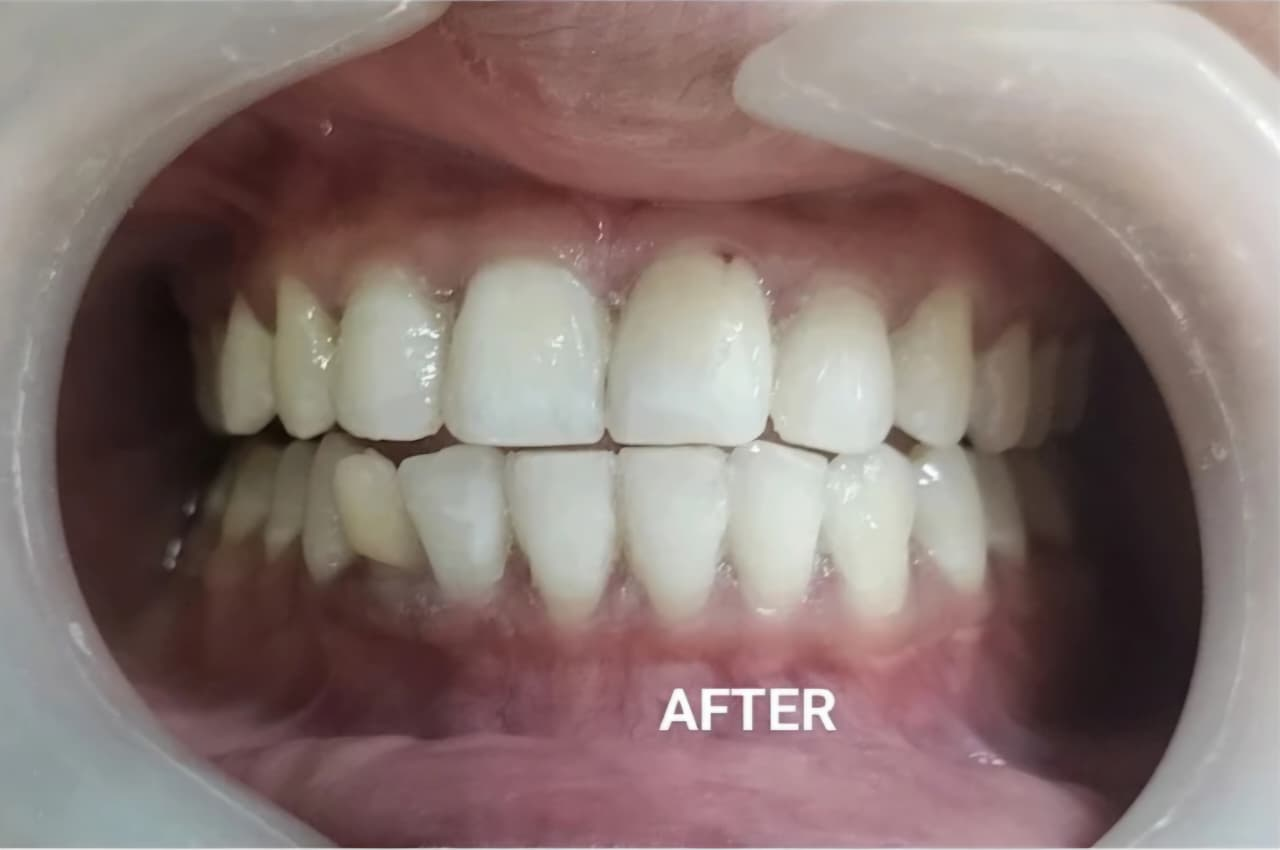 Smile Restoration after