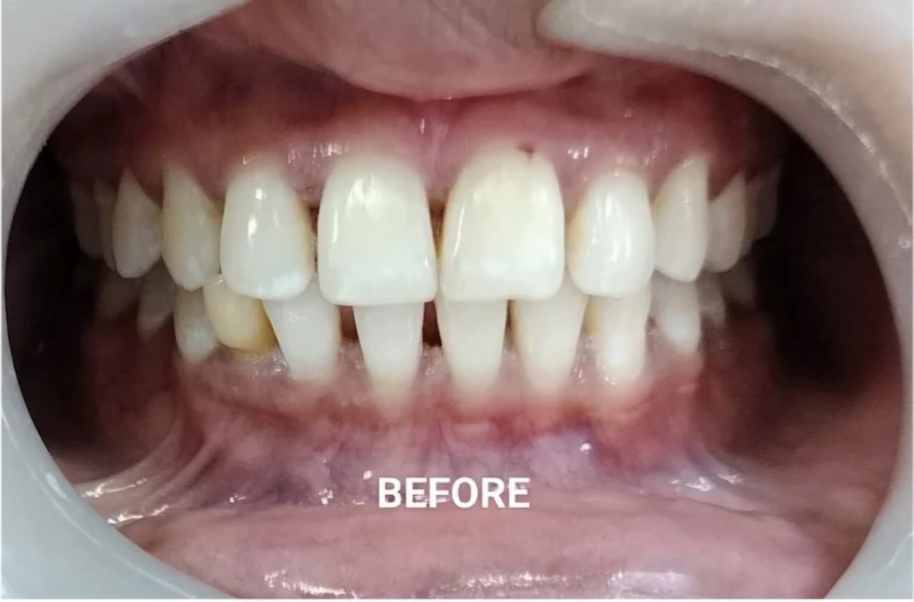 Smile Restoration before
